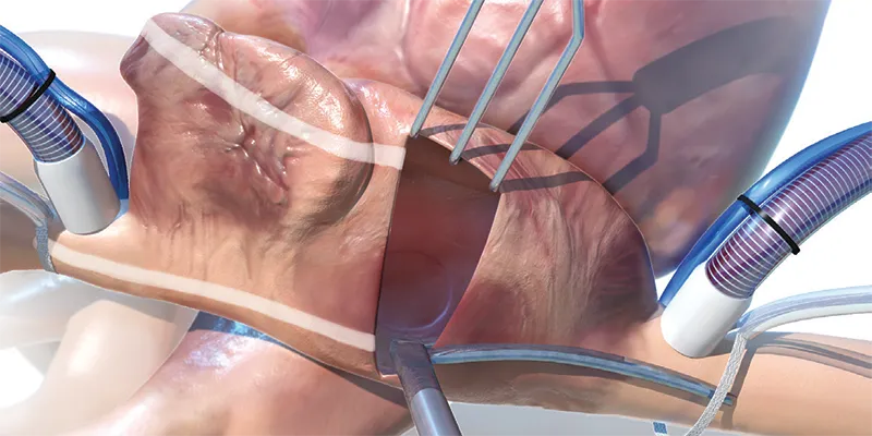 Lesion set illustration