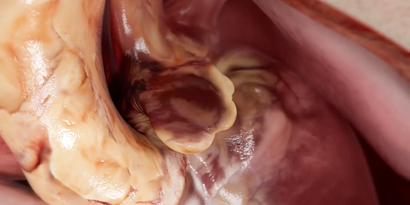 left atrial appendage exclusion